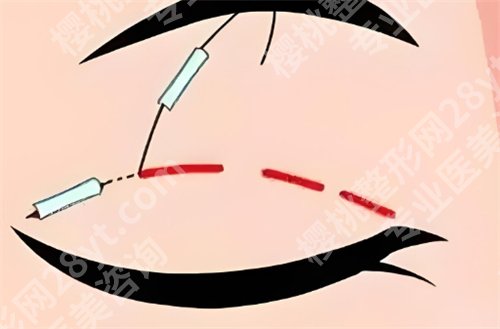 郑州杨丽医生割双眼皮好吗?医生介绍|特色项目