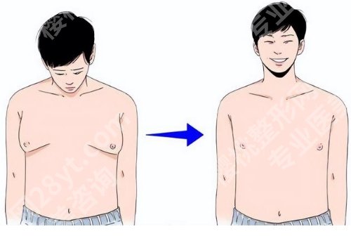毕晔医生做男性乳房肥大手术多少钱?医生实力测评|一键查看网友反馈