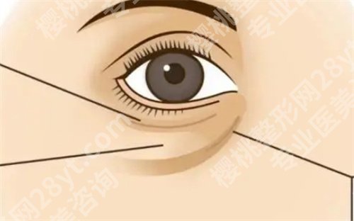 王阔远医生眼袋做的怎么样?医生技术靠谱|特色项目细节