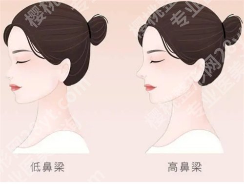 焦圆华做鼻子怎么样?项目疑问解答来了,速速了解吧