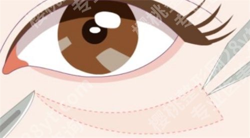 张晋宝去眼袋价格怎么样?医生详细介绍|口碑点评