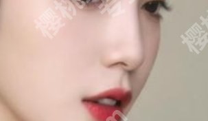 成都西区医院隆鼻怎么样?院内口碑医生推荐|真实案例参考