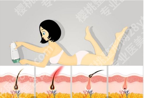 保定华美整形美容医院激光脱毛怎么样?在线点评查看,案例分享