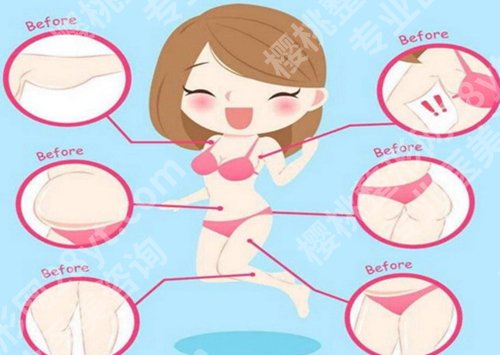 李春财吸脂怎么样?分享医生资料,含价格参考一览
