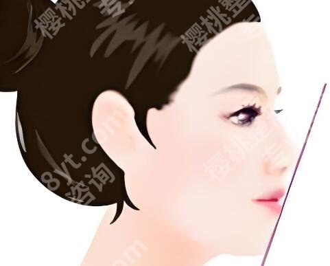 北京樱桃医疗美容诊所做鼻子多少钱?隆鼻价格为5000元起