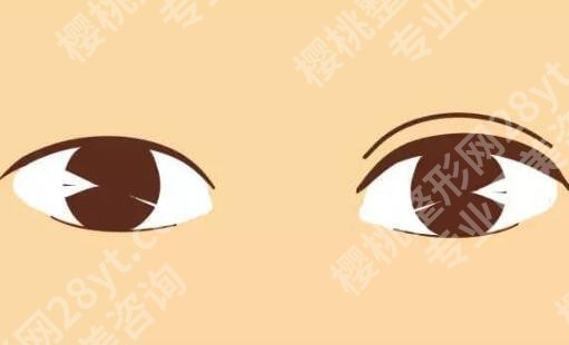 张朝蕾做双眼皮怎么样?在线发布专家资料,含热门案例过程