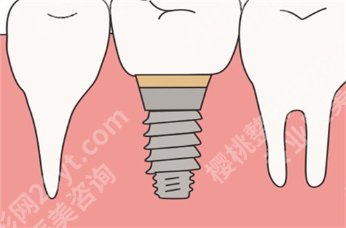 西尔口腔怎么样贵吗?价格带你了解起来