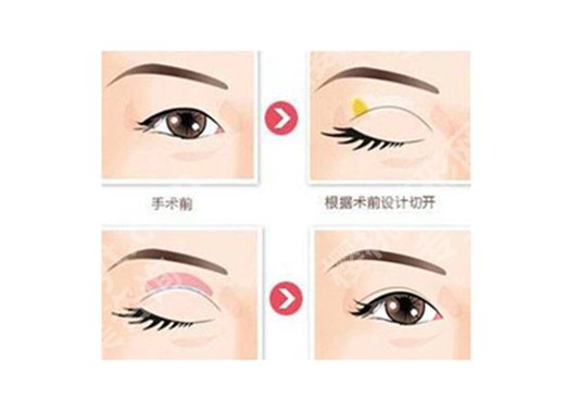 广州可玉整形医院做双眼皮怎么样?口碑点评一一查看