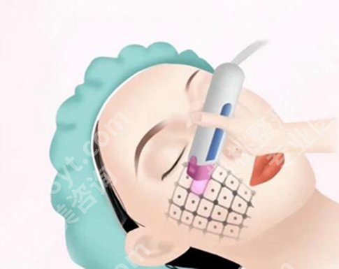 热玛吉有什么效果和副作用?在线查看热门项目介绍一览