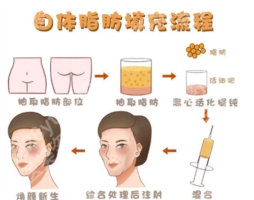 杭州郭同荣脂肪填充怎么样?坐诊医院、真实案例反馈来袭