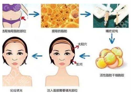 杭州郭同荣脂肪填充怎么样?坐诊医院、真实案例反馈来袭
