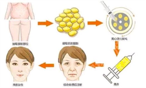 杭州郭同荣脂肪填充怎么样?坐诊医院、真实案例反馈来袭