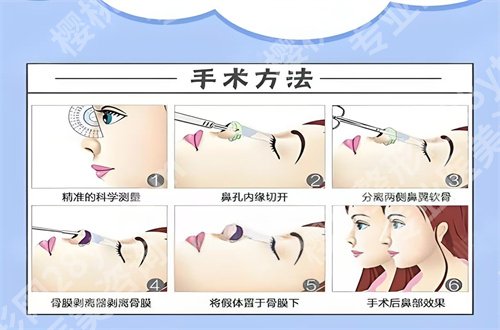 上海美之源整形门诊部隆鼻怎么样?详细看资料优势吧!