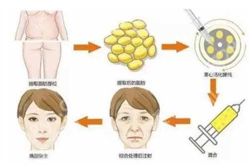美莱哪个医生打玻尿酸好?附价格解说,推荐了项目