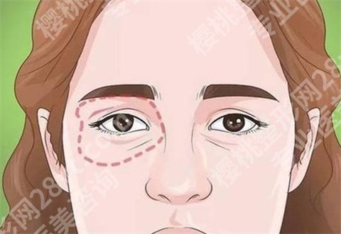 北京艺星去眼袋多少钱?热门案例公布,看术后反馈