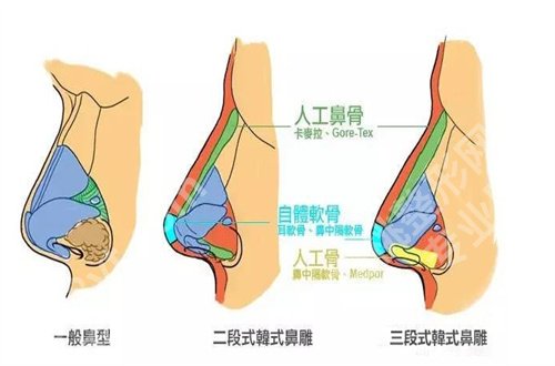 北京柏丽做鼻子好吗?真实案例反馈+价格表