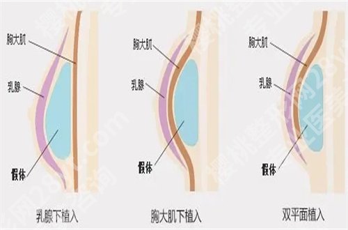 郝立君医生隆胸怎么样?技术优势已经整理,可看