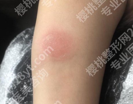 长沙湘雅医院美容科去疤痕手术费贵不贵?皮肤科医生推荐!