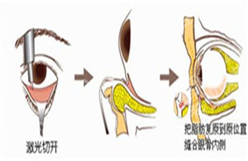 萧山人民医院祛眼袋怎么样?特色项目介绍