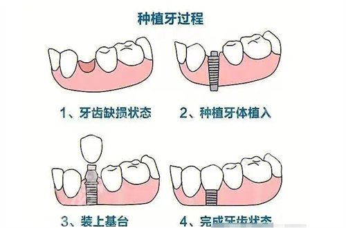 苏州大学附属第一医院牙齿矫正多少钱?附详情价格+案例解说