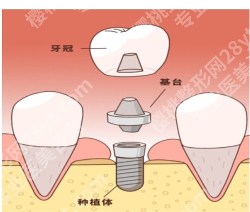 东莞塘厦医院种牙科怎么样?项目推荐榜单来袭