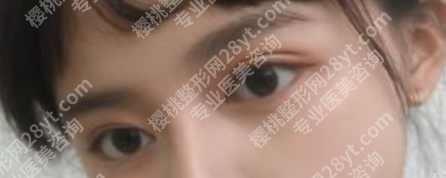 成都军大双眼皮哪个做得好?眼部手术案例反馈!术后贴士分享