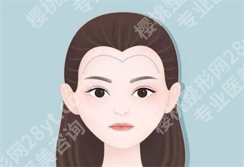 广东省人民医院植发科技术好不好?案例反馈