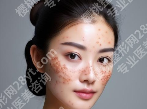 广医三院祛斑多少钱?斑点去除真实案例|见证TA的蜕变
