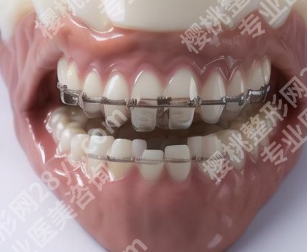 成都新桥矫正牙齿多少钱?医院做牙齿矫正的技术优势盘点!