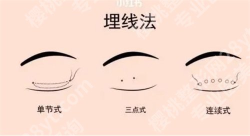 深圳米兰柏羽医学美容医院主打双眼皮吗?看推荐项目