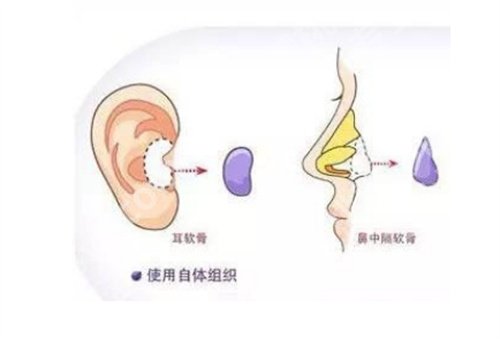 广州美恩隆鼻怎么样?技术实力曝光