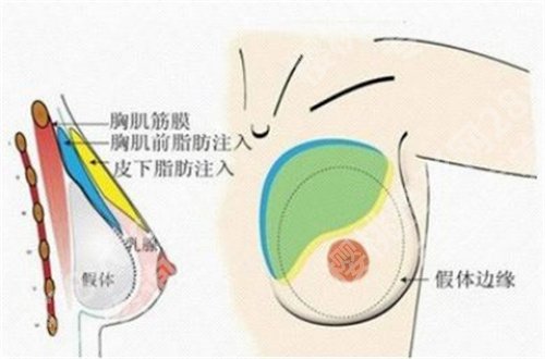 上海华美做胸有名的医生收费价格贵吗?2024年价格更新,一文查看