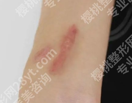 温州附属第一医院整形科疤痕的技术好不好?真人实例参考