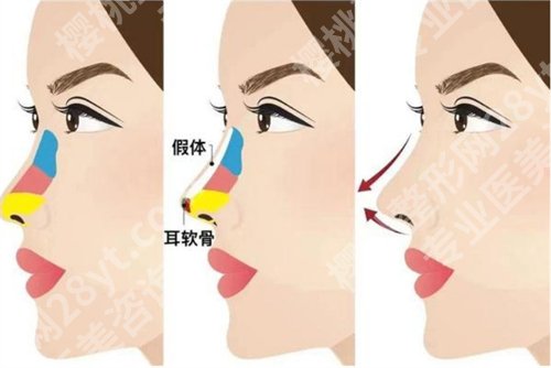 武汉王金州擅长什么?看肋骨隆鼻案例反馈