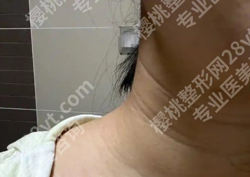 颈部除皱提升术有哪些方法?术后状态维持多久?