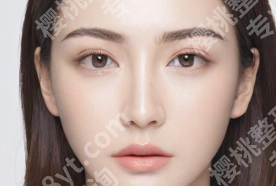 上海严红飞医生做双眼皮怎么样啊?赶紧来看看双眼皮案例过程反馈