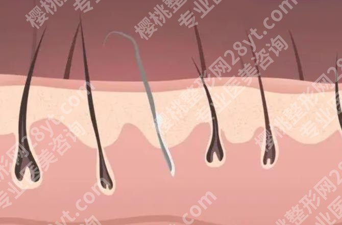 代庆成技术怎么样?植发技术优势盘点!近期案例反馈