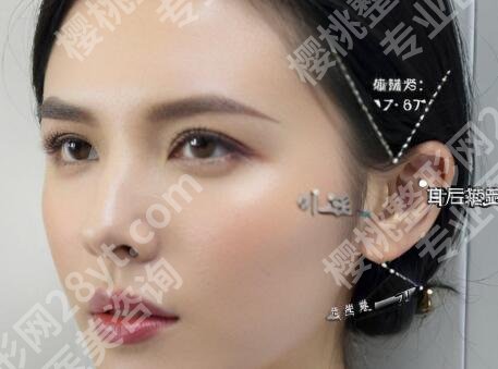 耳基底提升能保持多久?术后护理注意事项盘点!科普知识汇总!
