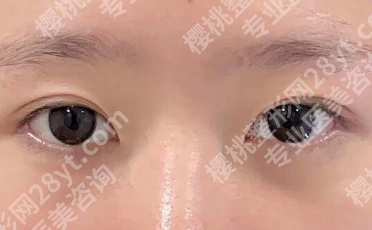 眼框下凹陷填充用什么方法好?效果可以维持多久?