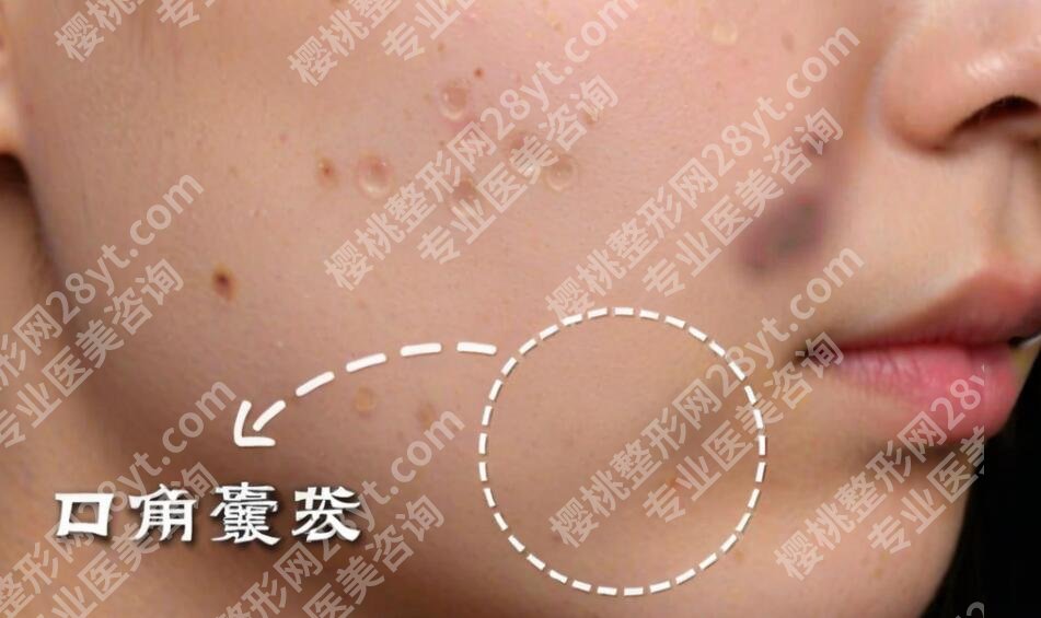 口角囊袋吸脂多少钱?影响费用变动的因素有哪些?戳进来看