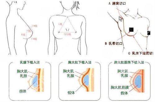 伯思立医院双眼皮做的怎么样?人气医生主推