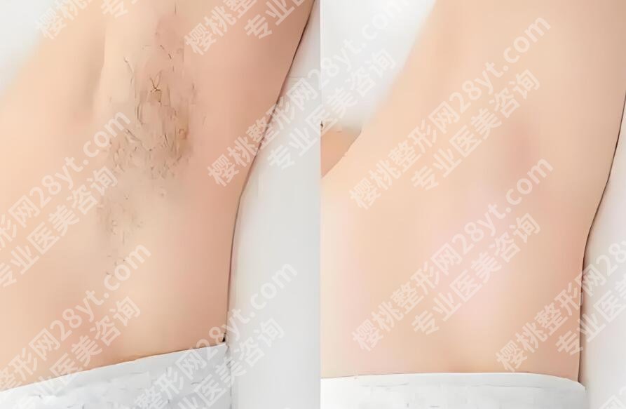 临海台州医院美容科做腋臭手术费用贵不贵?价目表出炉!