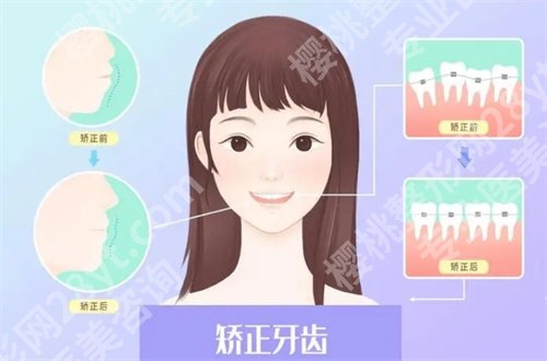 成都市第二人民医院牙齿矫正费用公布,附矫正案例