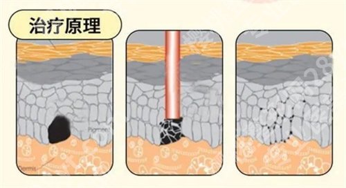 罗旭松切痣技术怎么样?一览医生技术点评