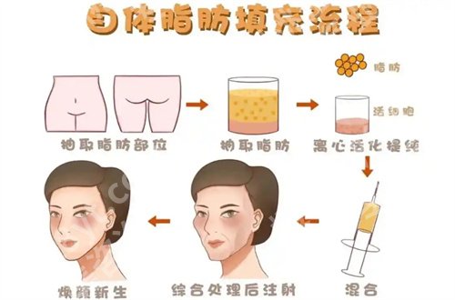 王荣锡脂肪填充怎么样?案例反馈+价格提示