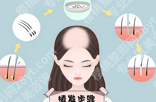 四川省人民医院植发价格是多少?2025价格表更新