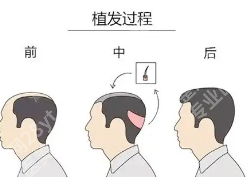 四川省人民医院植发价格是多少?2025价格表更新