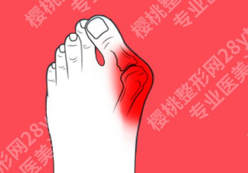 马桂文医生现在哪家医院?(大脚骨微创)做的怎么样?