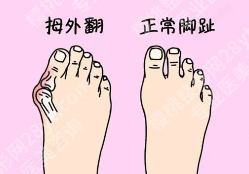 马桂文医生现在哪家医院?(大脚骨微创)做的怎么样?