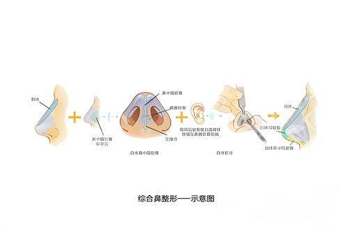上海刘名成医生怎么样?隆鼻技术大分析